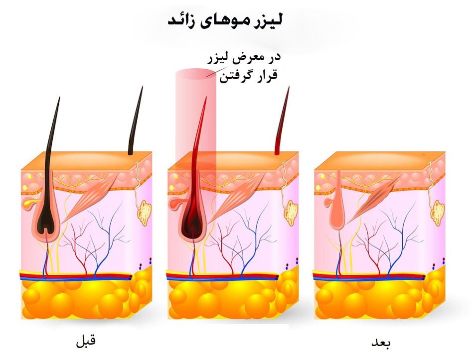 لیزر موهای زائد بدن