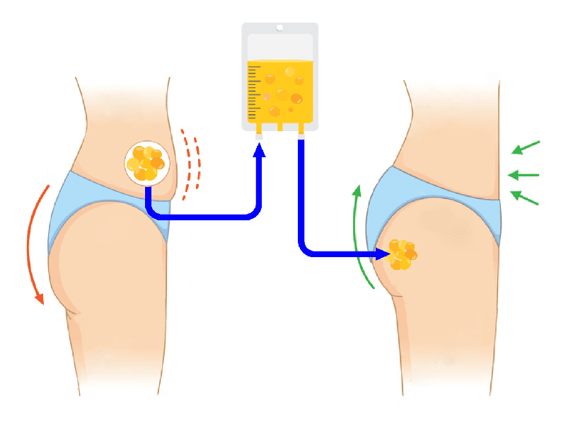 شیوه انجام تزریق چربی به باسن